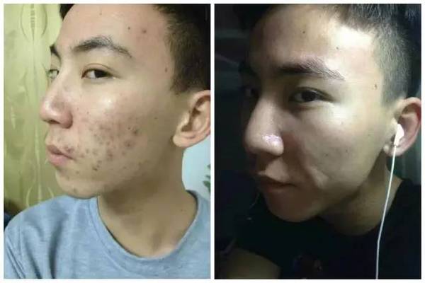 适合学生的祛痘方法，几个方法帮你告别痘痘!