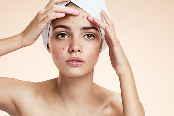 痘痘肌护肤六大注意事项